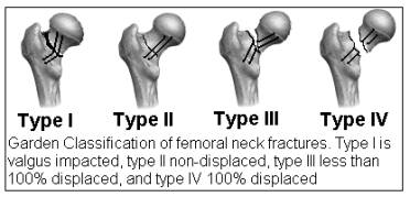 Garden Classification Of Hip Fractures