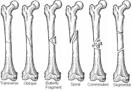 Orthopedic Terminology | Team Bone