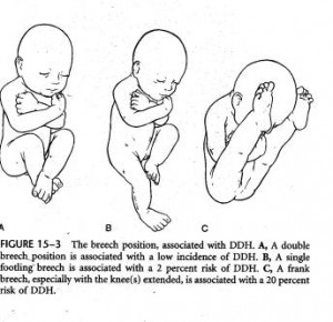 Developmental Dysplasia of the Hip | Team Bone