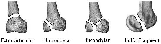 Distal Femur Knee and Tibial Plateau Team Bone