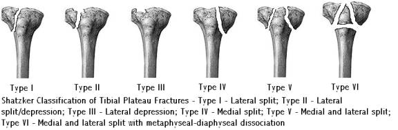Distal Femur Knee And Tibial Plateau Team Bone