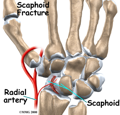 carpal bone fracture