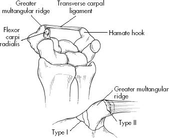 trapezium